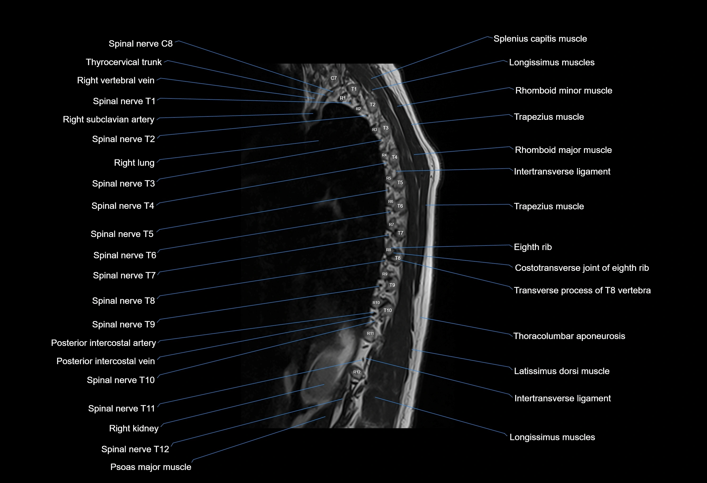 MRI thoracic spine sagittal  cross sectional anatomy 3T radiology  image-img-00001-00001.webp